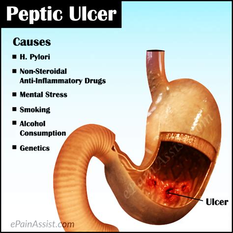 what is a peptic ulcer